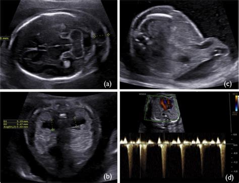 nuchal fold thickness measurement at 14 weeks|nuchal fold measurement chart.